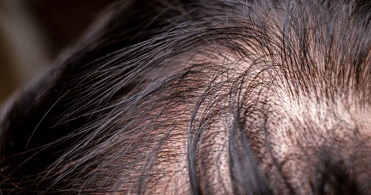 Main Reason For Hair Fall